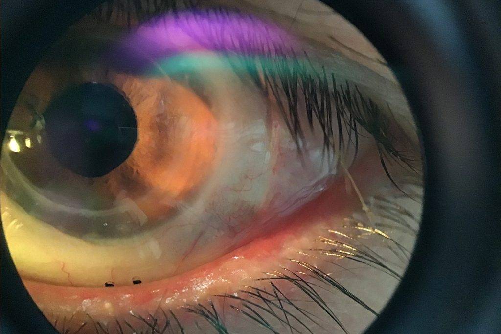 corneal degeneration treatment