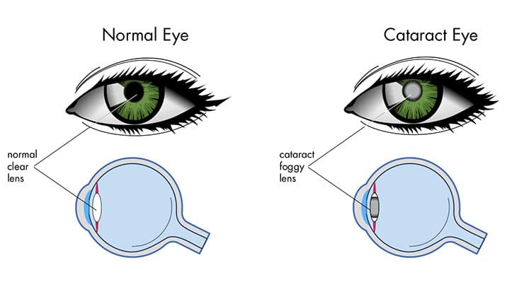 What Are Cataracts? - Optometrists.org